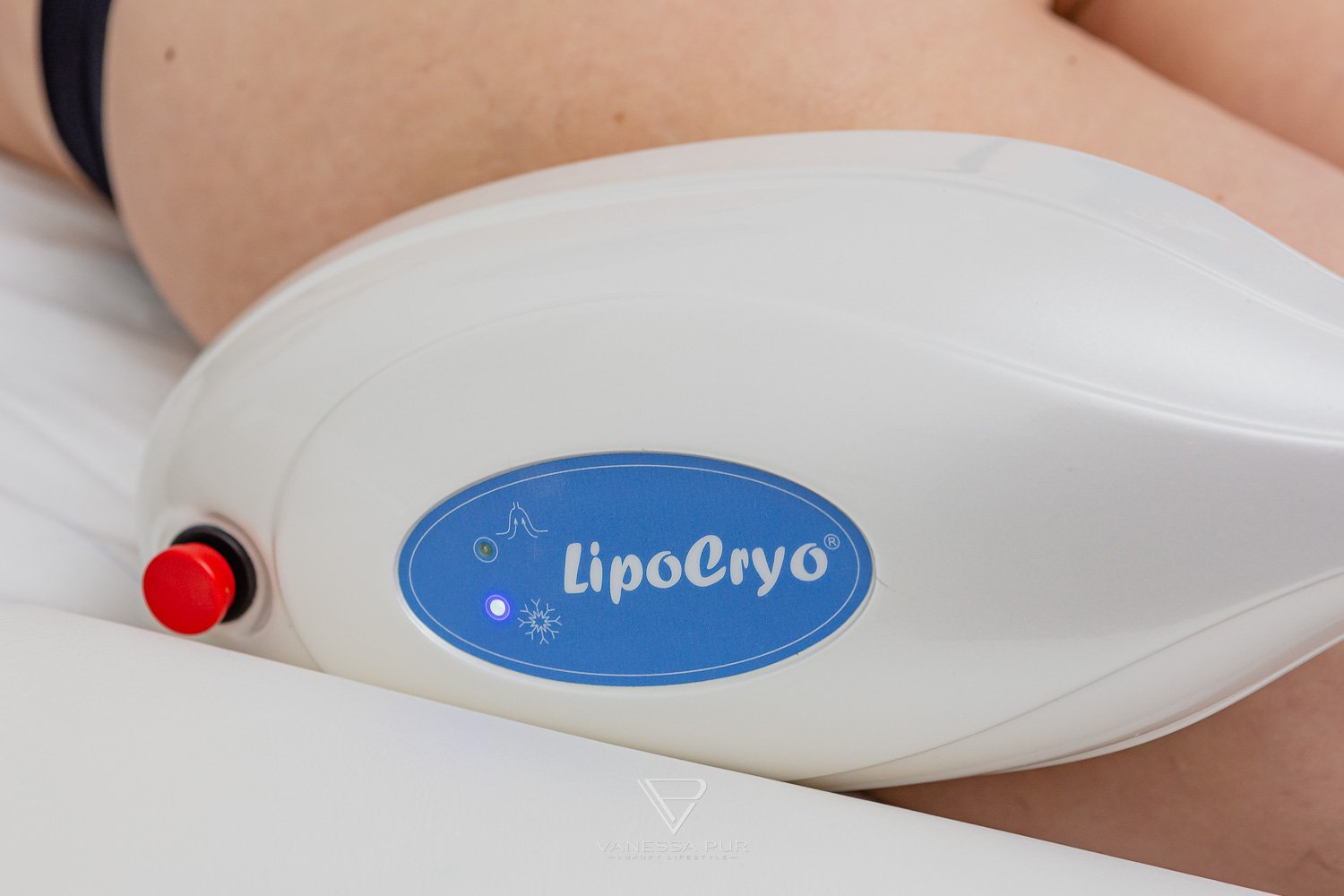 Cryolipolysis experience - reduce fat cells with cold 6 Cryolipolysis experience - reduce fat cells with cold - Fat reduction with cold - Long-term experience Long-term test - How are the experiences, hips, legs, abdomen, buttocks