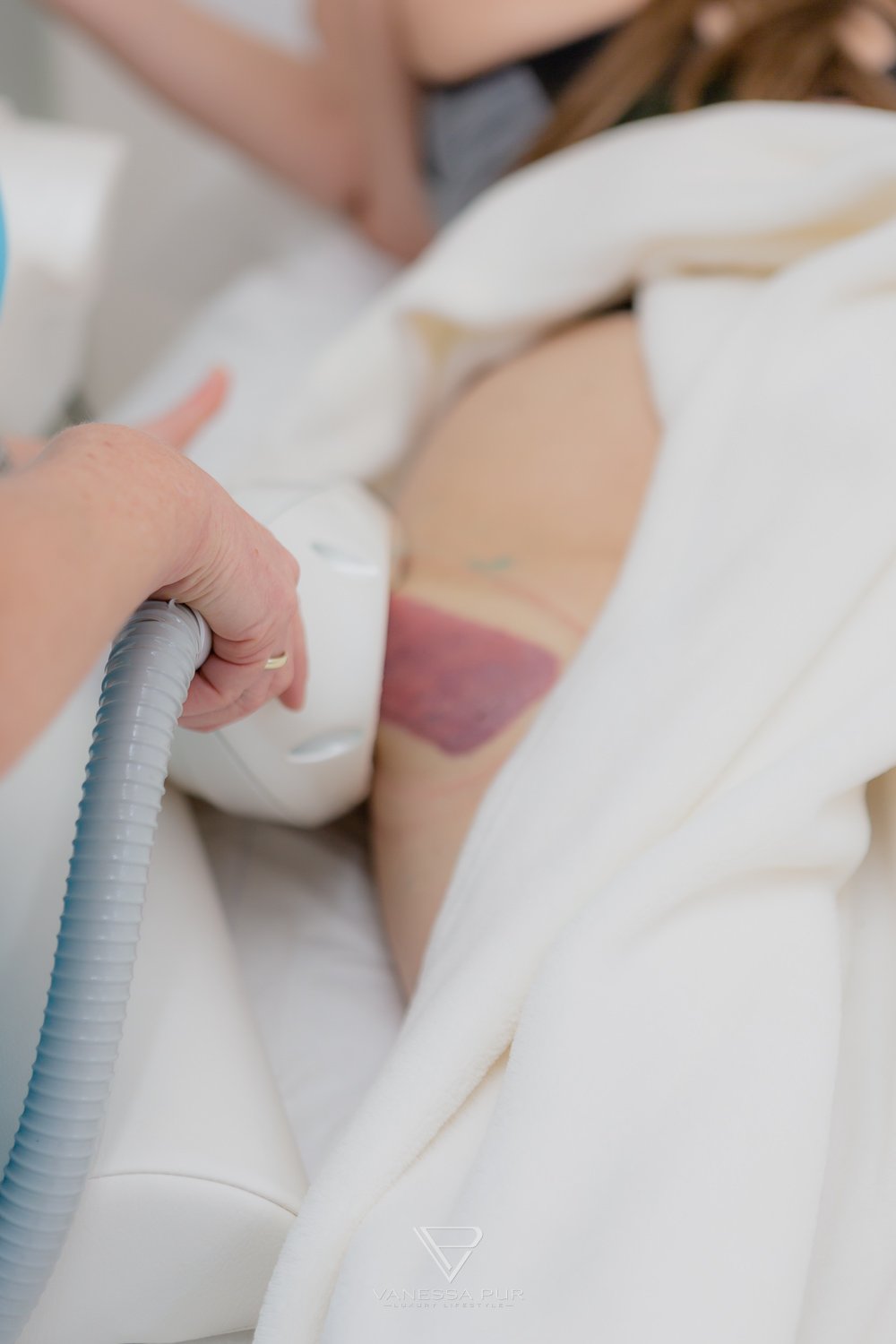Cryolipolysis experience - reduce fat cells with cold 3 Cryolipolysis experience - reduce fat cells with cold - Fat reduction with cold - Long-term experience Long-term test - How are the experiences, hips, legs, abdomen, buttocks