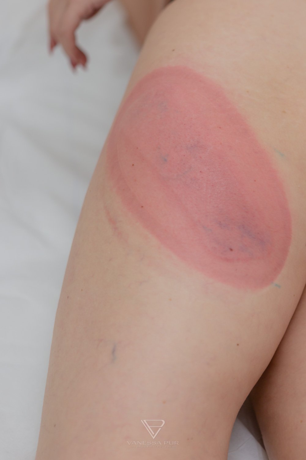 Cryolipolysis experience - reduce fat cells with cold 4 Cryolipolysis experience - reduce fat cells with cold - Fat reduction with cold - Long-term experience Long-term test - How are the experiences, hips, legs, abdomen, buttocks